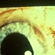 Ciliary Body Tumor Ciliary Body Tumor